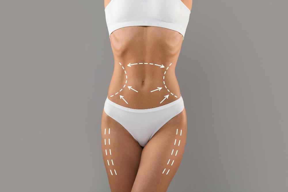 liposuctie