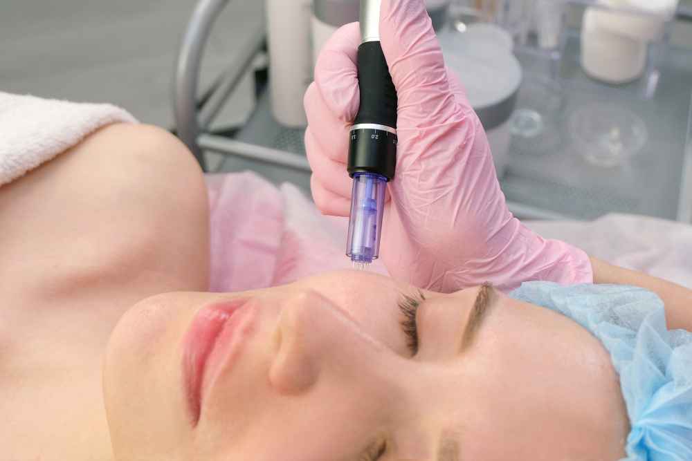 microneedling microneedling